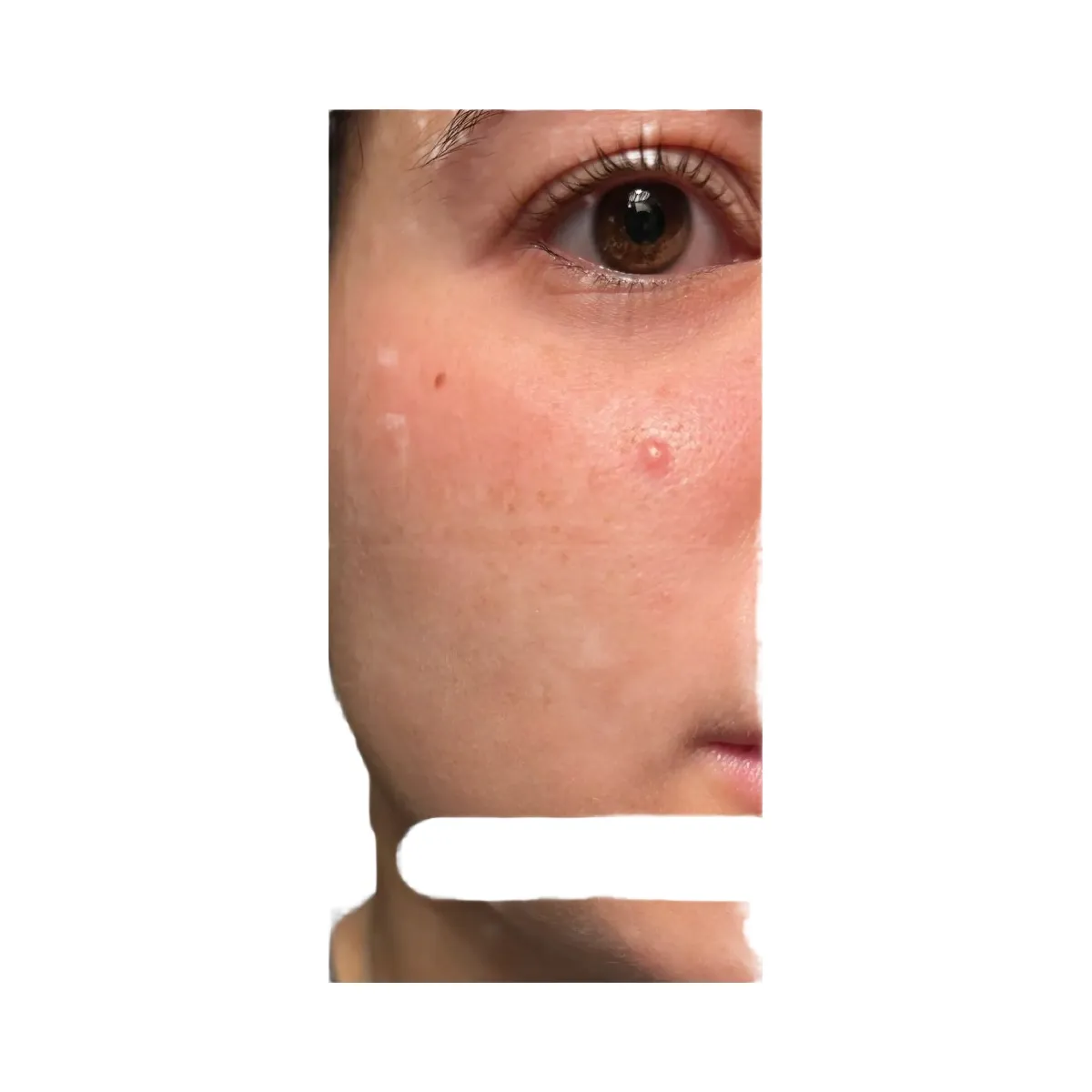 good light Luna Fast Acting Pimple Patches