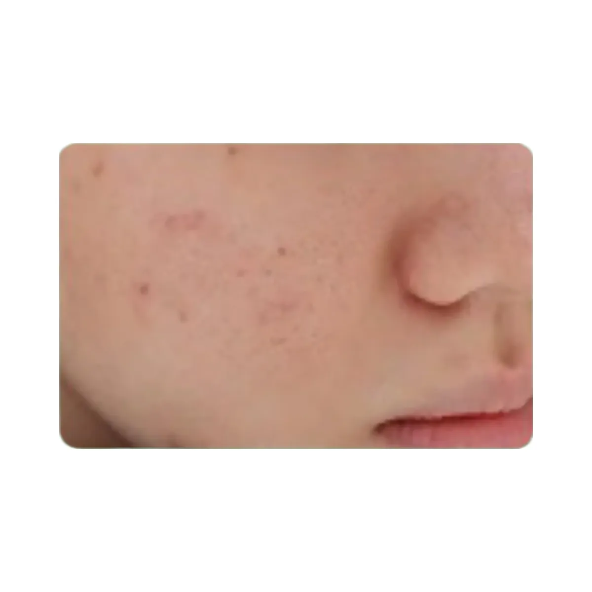 MEDIHEAL Teatree Calming Hydra Serum