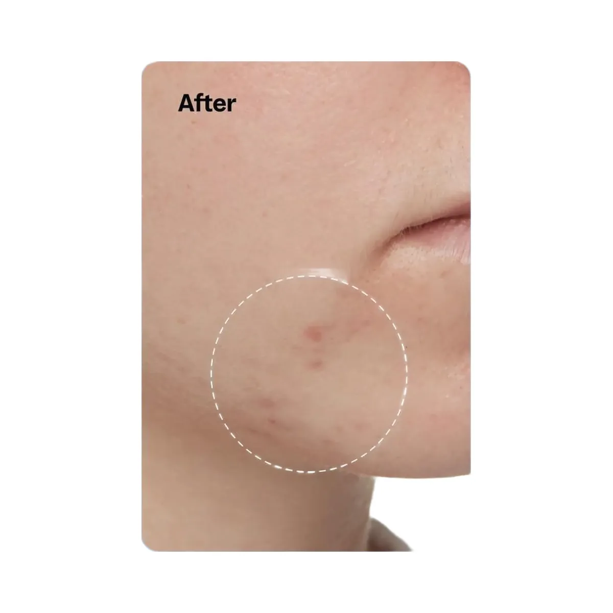 Peach Slices 3-Step Acne Starter Kit
