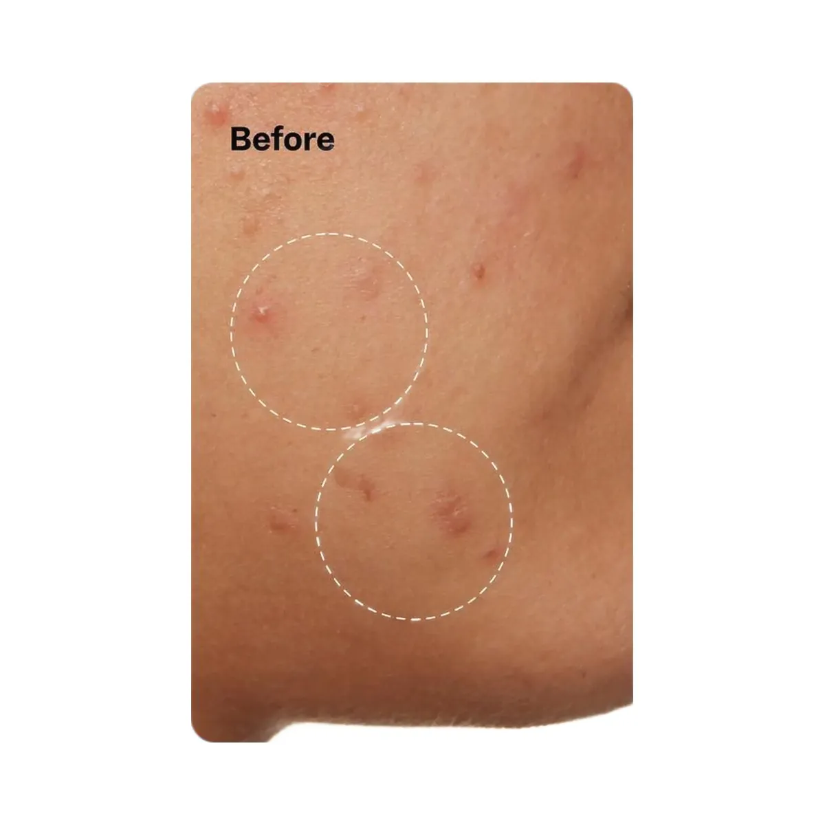 Peach Slices Acne Clarifying Cleanser