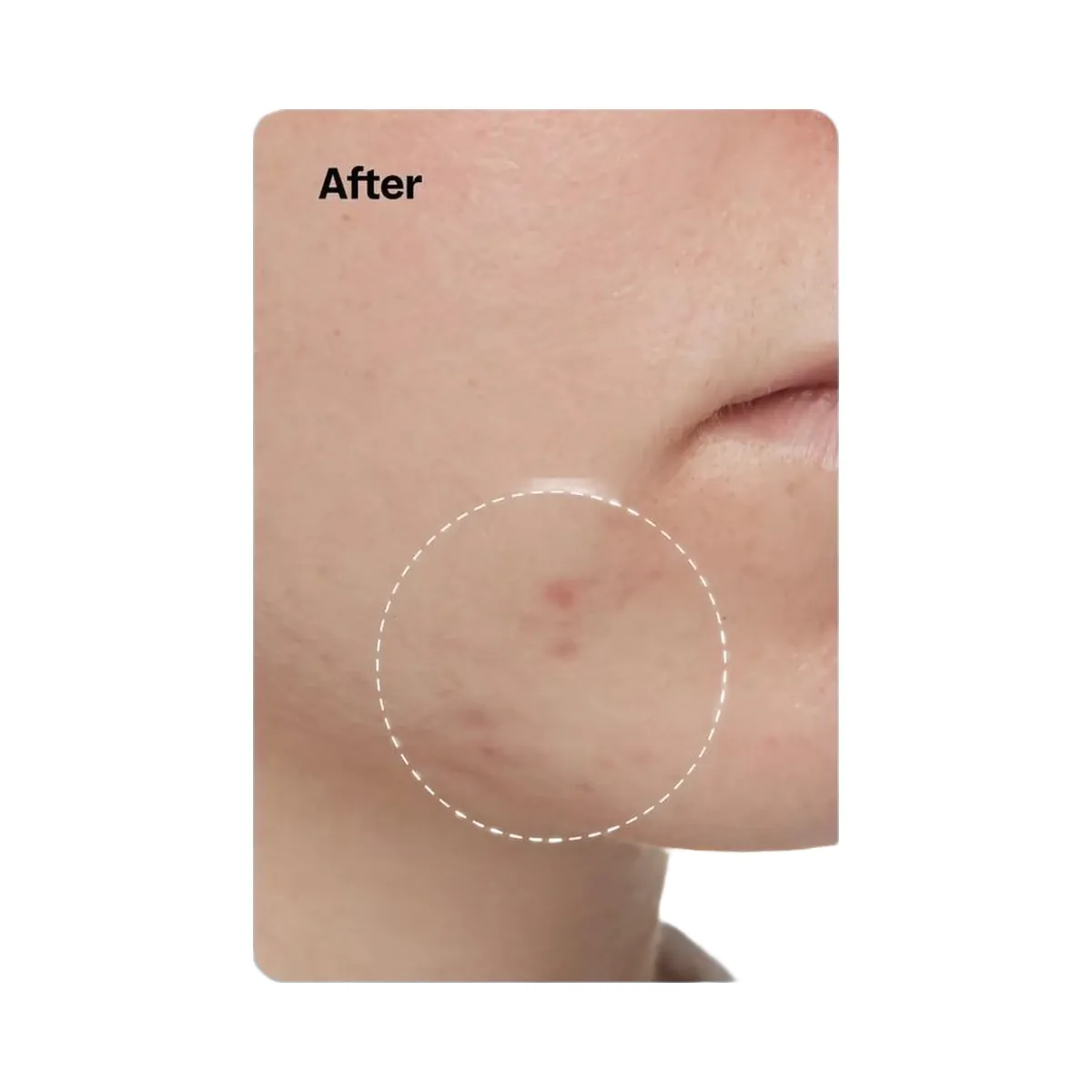 Peach Slices Acne Exfoliating Toner