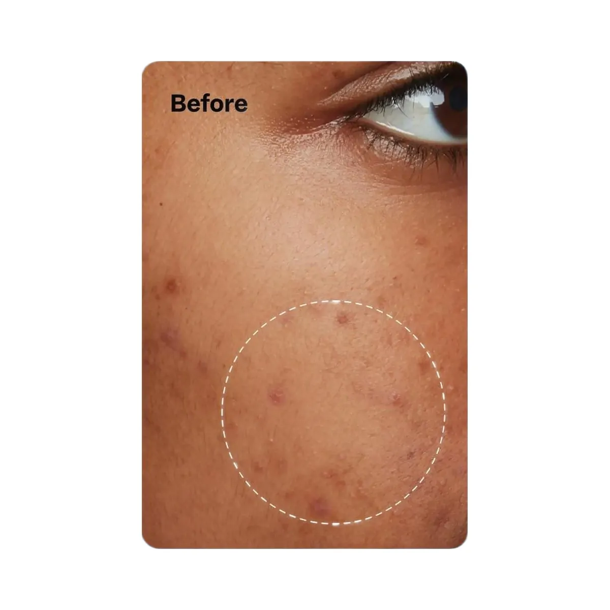 Peach Slices Acne Oil-Free Moisturizer
