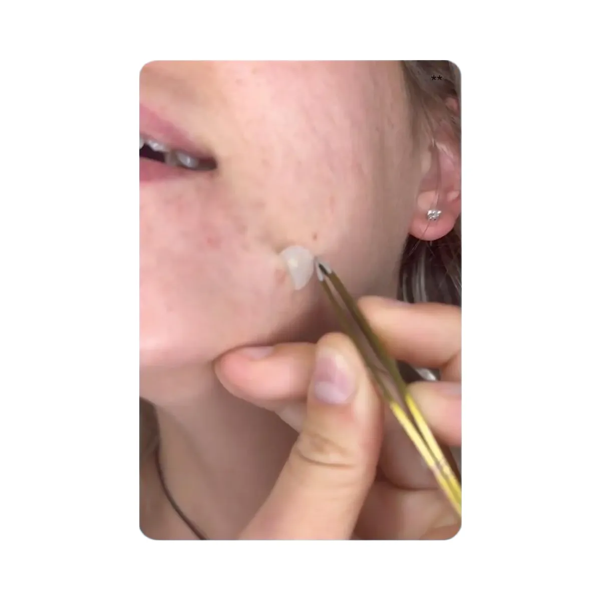 Peach Slices Acne Spot Dots