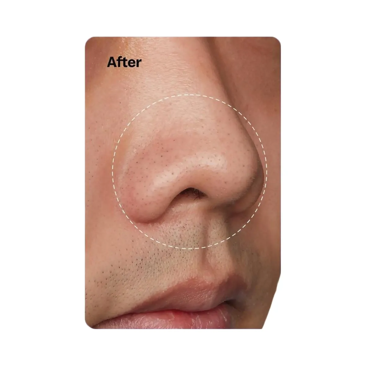 Peach Slices Nose Pore Patches